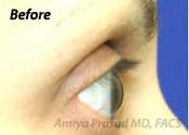 before eyelash transplant - side view