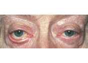 eyelid repair ectropian