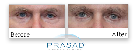 eyelid surgery patient review with before and after photo