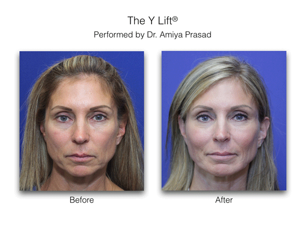 before and after Y Lift® treatment, female patient