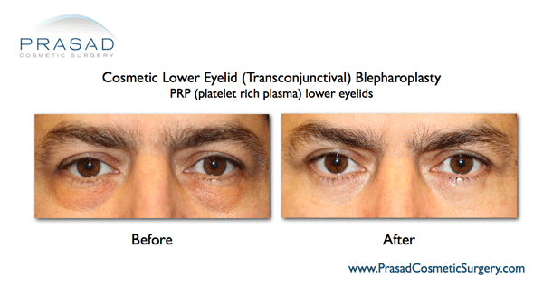 lower eyelid blepharoplasty with PRP