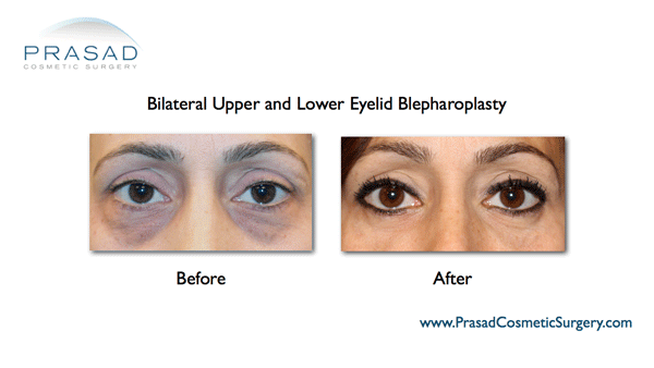 lower eyelid bleph with PRP and CO2