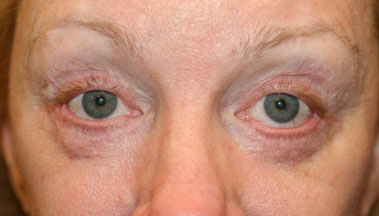 This woman has lower eyelid retraction underwent reconstructive eye lift revision to correct the problem