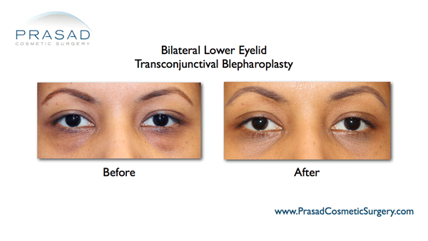 lower eyelid transconjunctival blepharoplasty