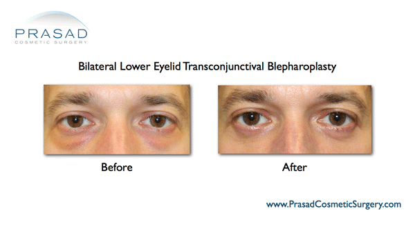 lower eyelid transconjunctival blepharoplasty
