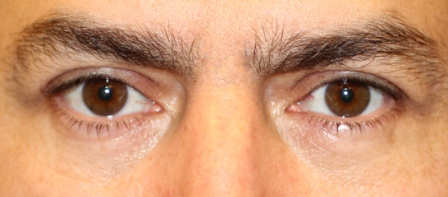 after male blepharoplasty