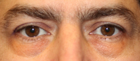 before male blepharoplasty