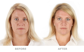 prp injections before and after treatment