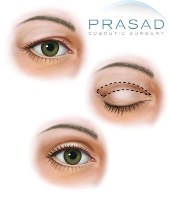 age-related upper blepharoplasty illustration