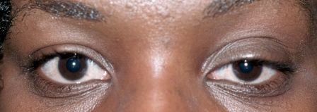 female patient with drooping left eye