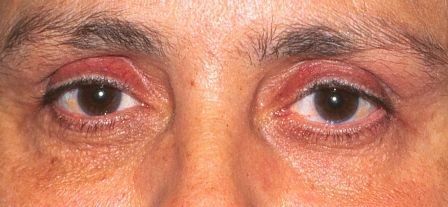 patient after ptosis correction surgery