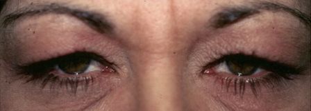 woman in 40s with drooping eyes before ptosis surgery