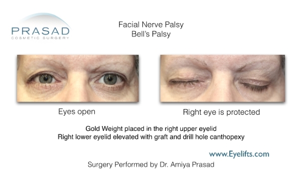 surgical correction of facial nerve palsy or Bells palsy using gold weight and repair of lower eyelid retraction with Enduragen graft performed by Amiya Prasad MD