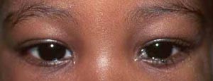 eyelid problems in children - Eye Tearing 