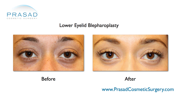 before and after lower eyelid blepharoplasty