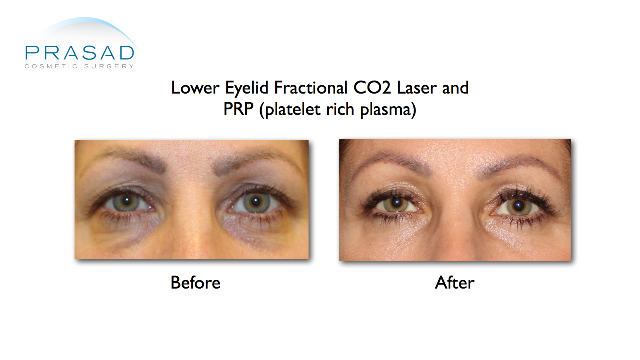Hollow eyes treatments with laser and PRP, before and after results
