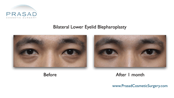 Lower Eyelid Surgery - Eyelifts by Dr. Amiya Prasad MD, FACS