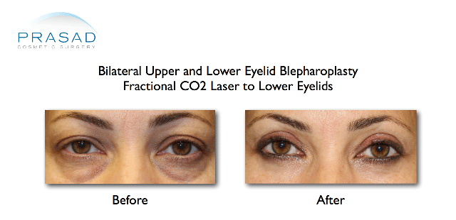 upper and lower eyelid blepharoplasty prp to lower eyelids