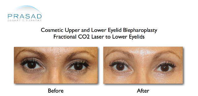 upper and lower eyelid blepharoplasty