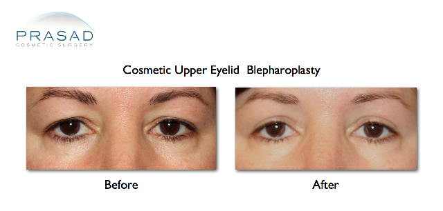 upper eyelid blepharoplasty